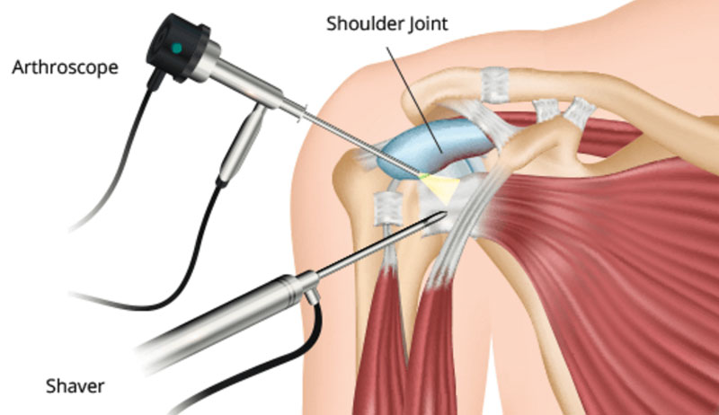 Arthroscopic treatment for weight lifters in South Delhi