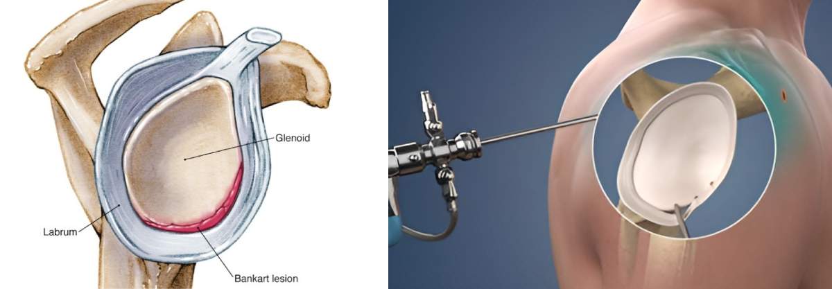 elbow treatment in gurgaon